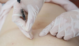 埋线减肥视频全过程,埋线减肥全过程揭秘